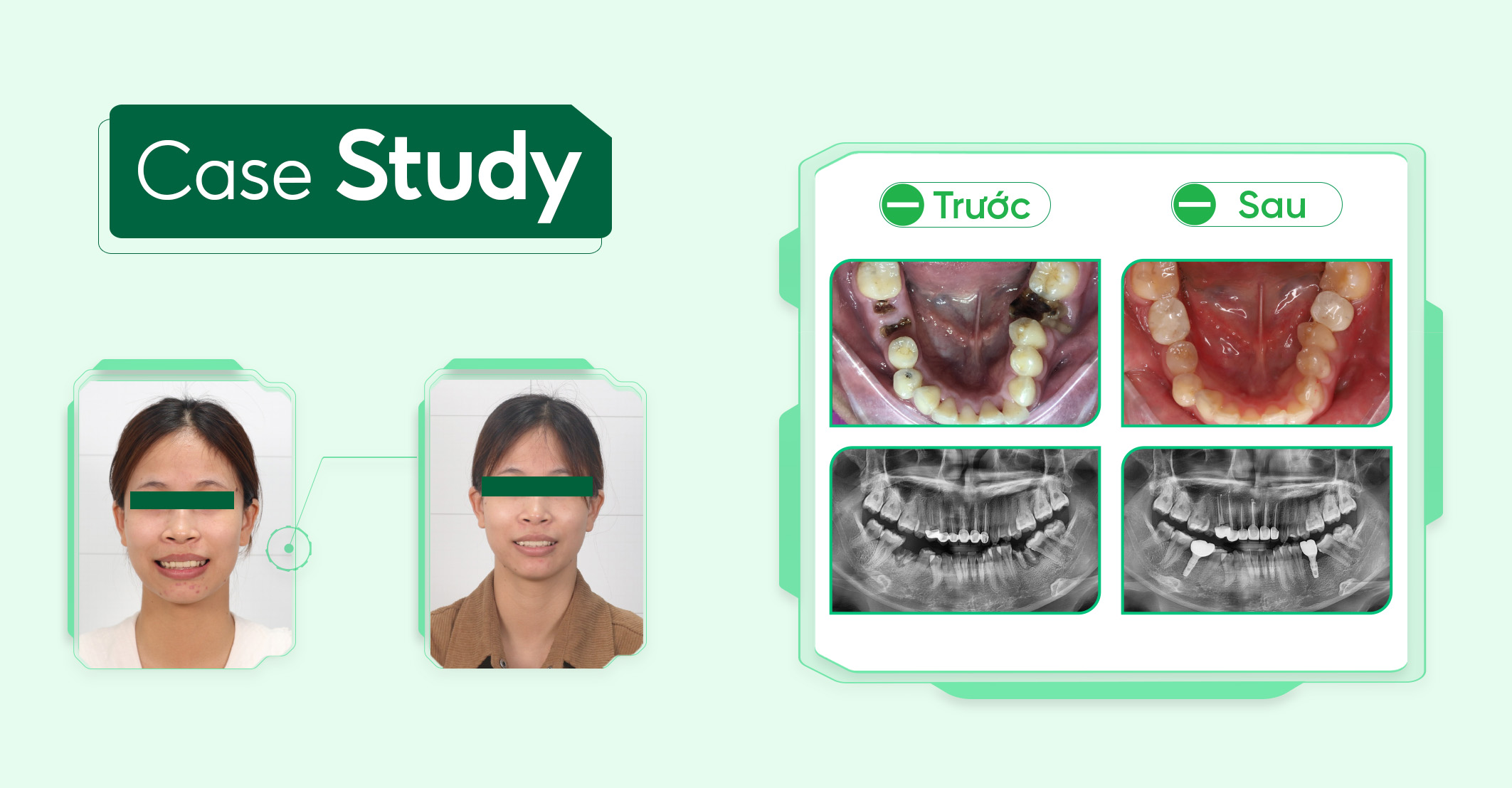 Case-implant-vai-rang ( 1)