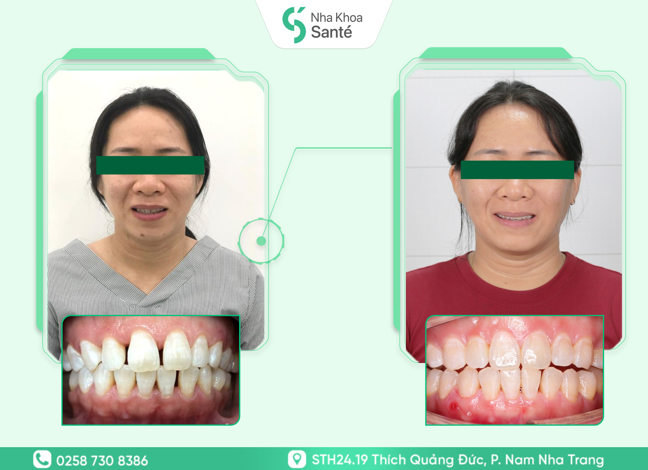 Case-invisalign ( 1 )