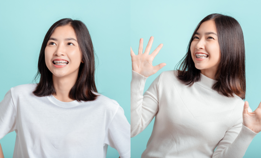 Trước Và Sau Niềng Răng - Hành Trình Biến Đổi Nụ Cười Tại Nha Khoa Santé