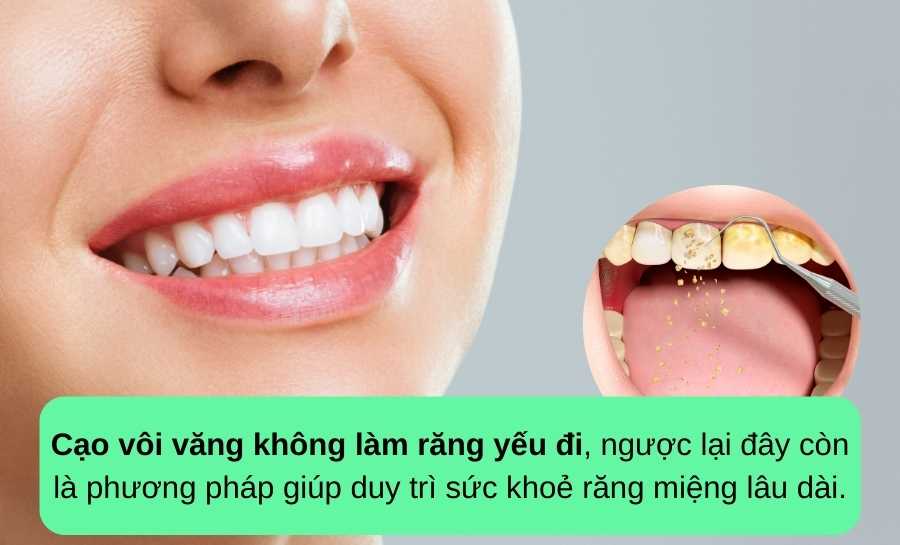Cạo Vôi Răng Có Làm Răng Yếu Đi Không? Những Lưu Ý Từ Nha Sĩ