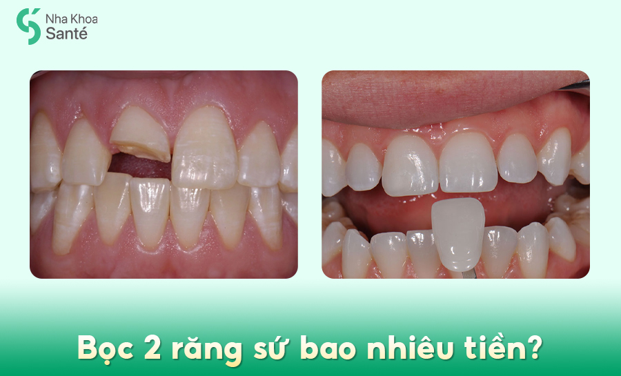 Bọc răng sứ 2 Răng cửa bao nhiêu tiền? Giá cập nhật mới nhất 2025