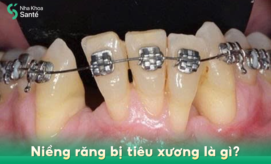 Niềng Răng Bị Tiêu Xương: Dấu Hiệu Nhận Biết Và Cách Phòng Tránh Hiệu Quả