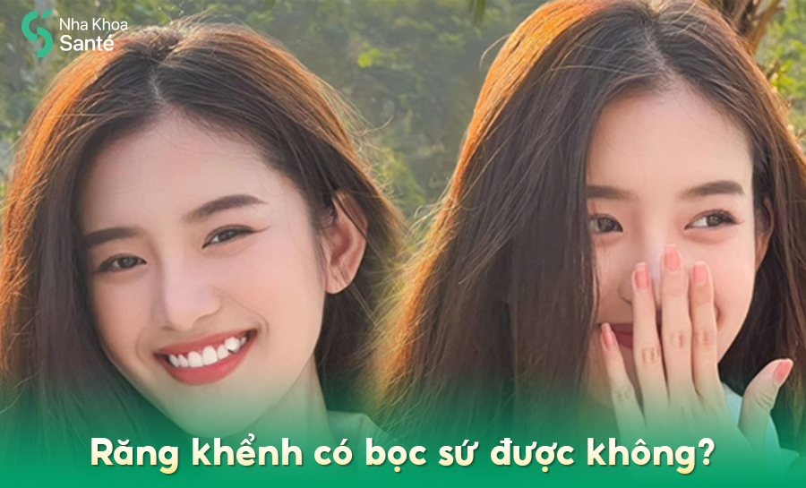 Răng Khểnh Có Bọc Được Răng Sứ Không? Giải Đáp Từ Chuyên Gia Nha Khoa