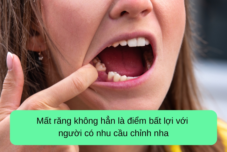 Mất Răng Có Niềng Được Không? Giải Đáp Chi Tiết Cho Từng Trường Hợp
