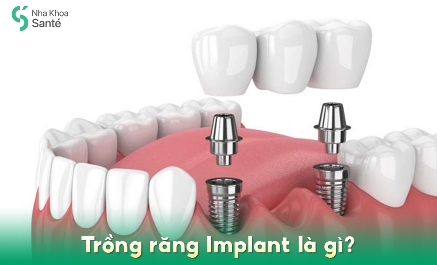 Quy Trình Trồng Răng Implant: Các Bước Thực Hiện Và Thời Gian Phục Hồi