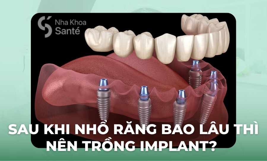 Sau Khi Nhổ Răng Bao Lâu Thì Trồng Implant? Thời Điểm Thích Hợp Nhất