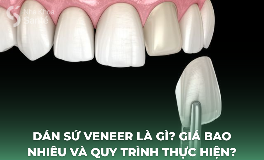 Dán Sứ Veneer Là Gì? Giá Bao Nhiêu Và Quy Trình Thực Hiện?