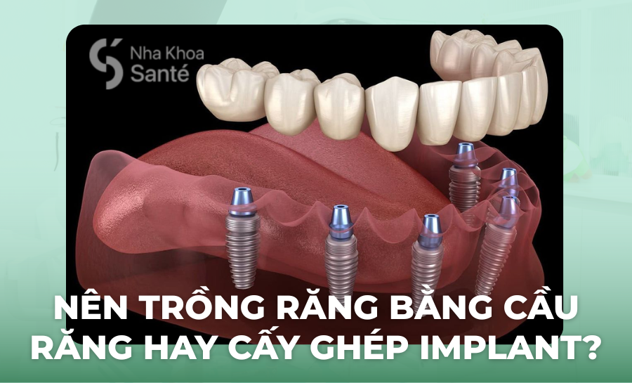 Nên Trồng Răng Bằng Cầu Răng Hay Cấy Ghép Implant?
