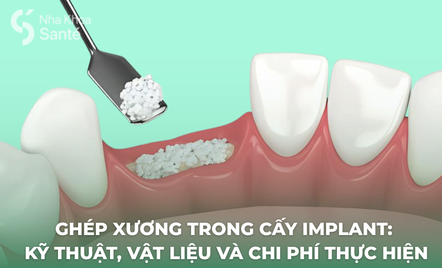 Ghép Xương Trong Cấy Implant: Kỹ Thuật, Vật Liệu Và Chi Phí Thực Hiện