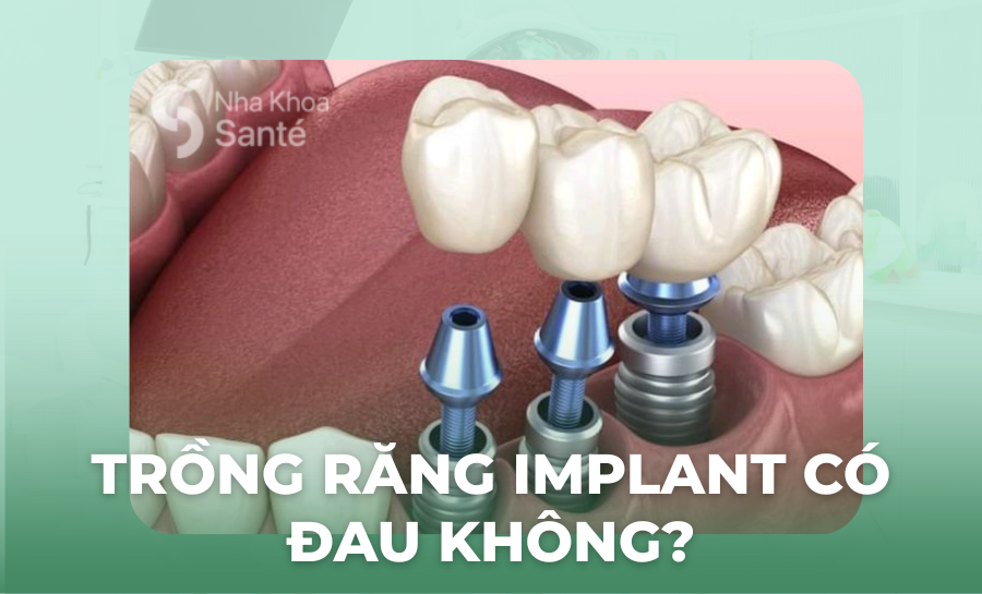 Trồng Răng Implant Có Đau Không? Giải Đáp Chi Tiết Từ Bác Sĩ Nha Khoa