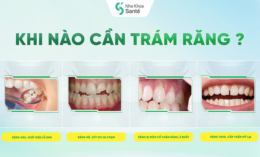 Quy Trình Trám Răng - Những Bước Cần Biết Trước Khi Thực Hiện