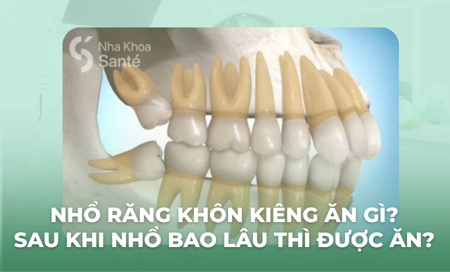 Nhổ Răng Khôn Kiêng Ăn Gì? Sau Khi Nhổ Bao Lâu Thì Được Ăn?