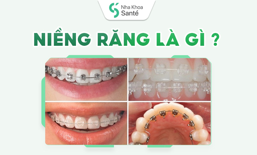 Niềng Răng Thẩm Mỹ: Giải Pháp Sở Hữu Nụ Cười Đều Đẹp – Chuẩn Y Khoa